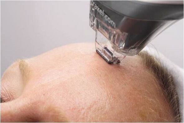 yüz cilt gençleştirme için peeling prosedürü